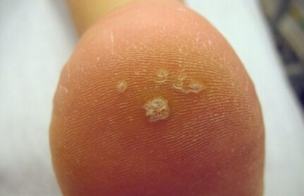 Nola aitortu Pierce Wart
