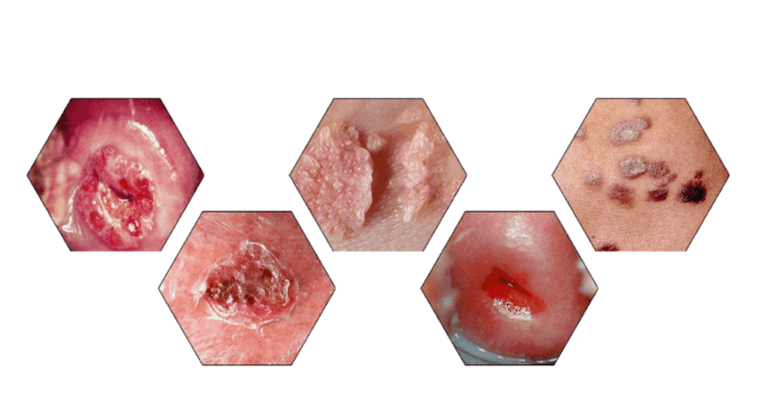 Zergatik dira arriskutsuak papilomak