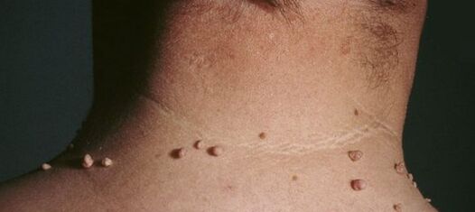 nola papilomak kentzeko