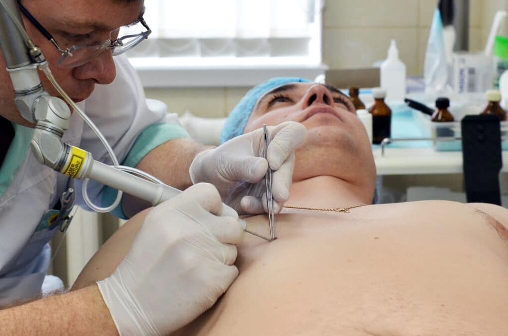 nola kendu gorputzeko garatxoak