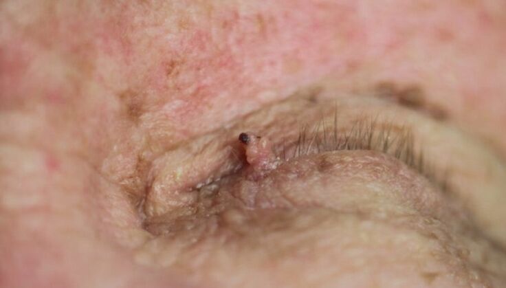 papilloma betazalen nola kendu