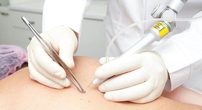Papiloma birusaren papilloma laser kentzea